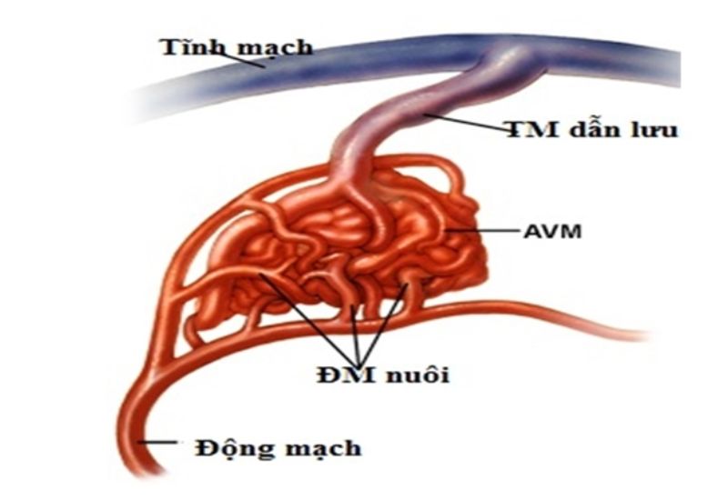 mô tả dị dạng động tĩnh mạch não 