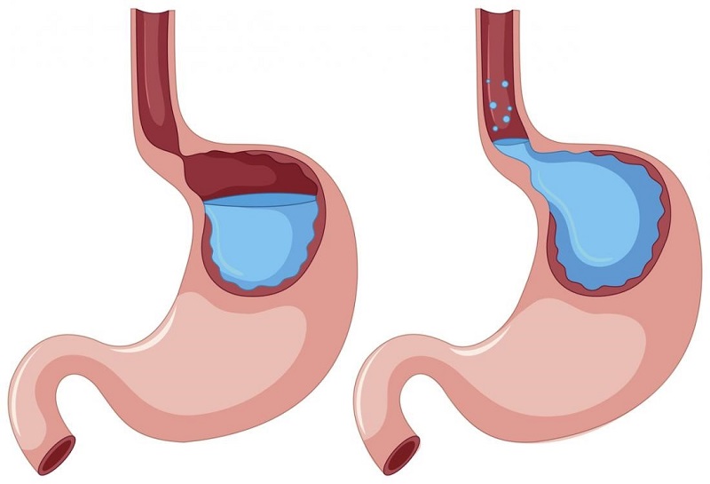Nguyên nhân bị ợ hơi thường gặp