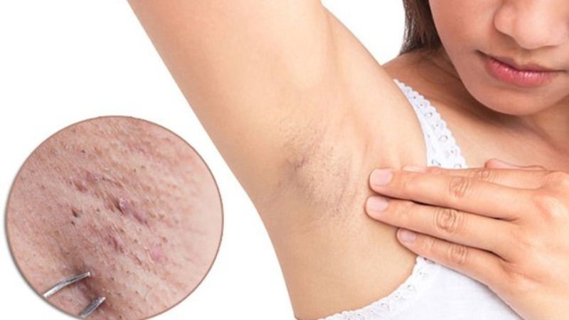 áp xe ở nách do nhổ lông nách không đúng cách