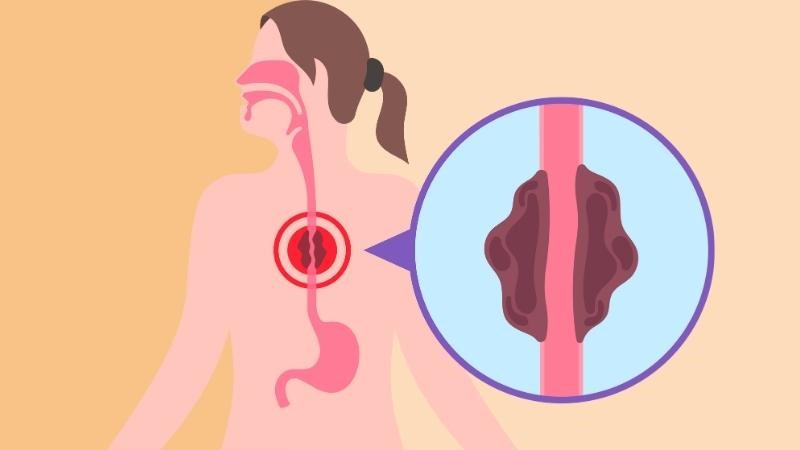 Nguyên nhân gây nuốt nghẹn