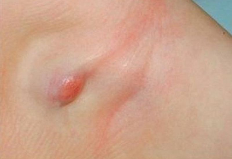 u bã đậu ở nách dễ bị nhầm lẫn với áp xe