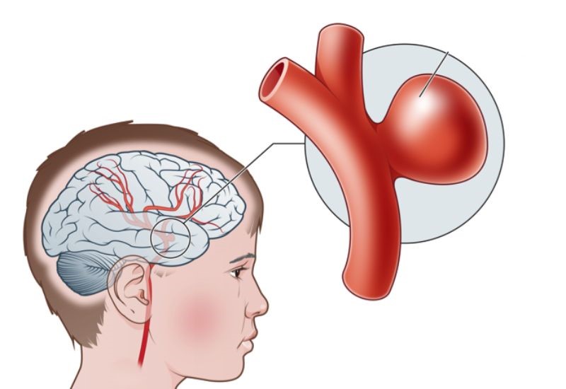 Tình trạng phình mạch não ở người trẻ đang gia tăng