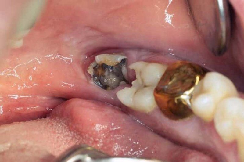 Cấu trúc phức tạp của răng trong cùng cũng khiến răng dễ bị sâu hơn.