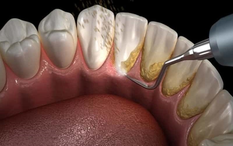 Giải đáp thắc mắc về chi phí tẩy vôi răng bao nhiêu tiền