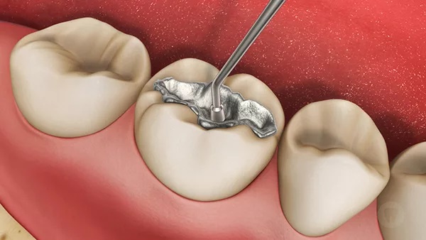 Trám răng thẩm mỹ bao nhiêu tiền sẽ phụ thuộc vào nhiều thứ.