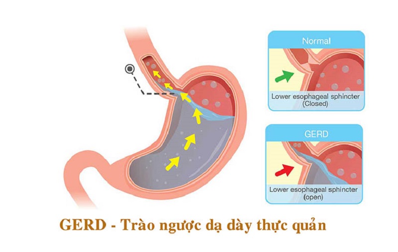 Bệnh trào ngược dạ dày thực quản