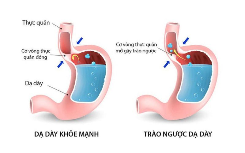 triệu chứng viêm thực quản