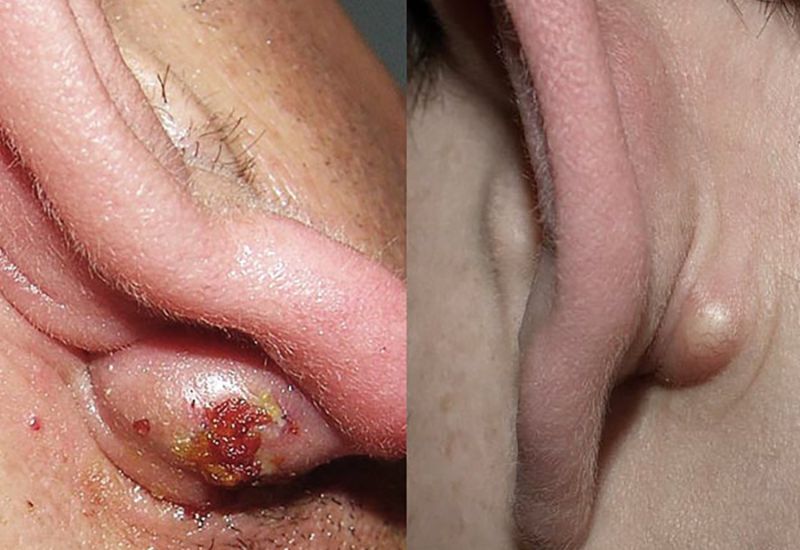 trị u bã đậu tại nhà coi chừng biến chứng nguy hiểm