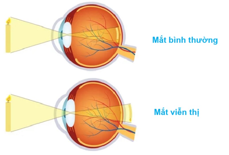 Viễn thị làm thay đổi cấu trúc nhãn cầu