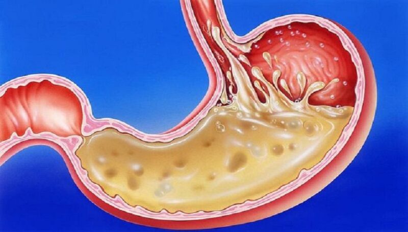 viêm thực quản trào ngược độ B