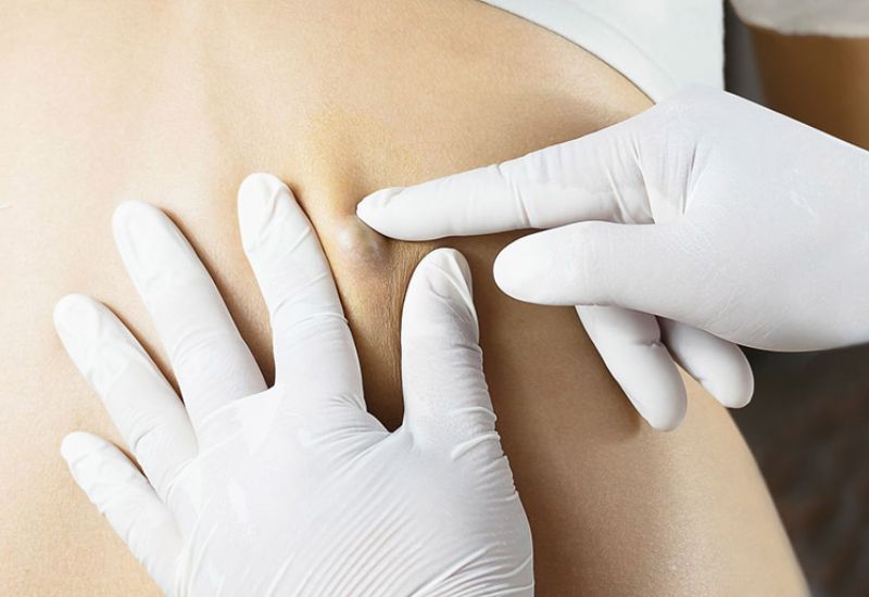 mẹo chữa u bã đậu bằng phương pháp dân gian 