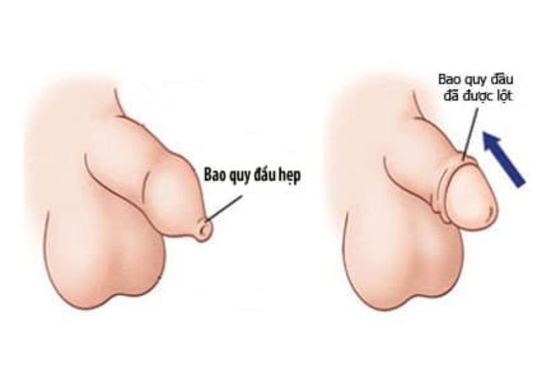 hẹp bao quy đầu ở trẻ em