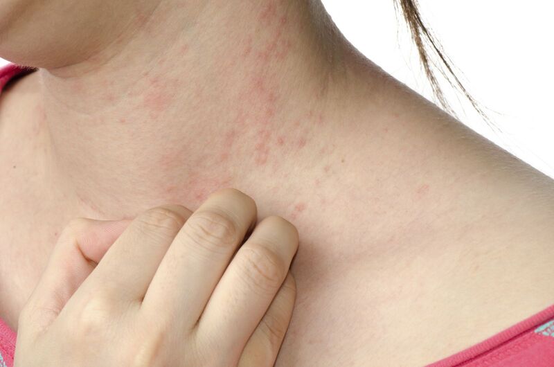 Nguyên nhân chính của dị ứng là do hệ miễn dịch nhận diện sai những chất thông thường thành mối đe dọa.