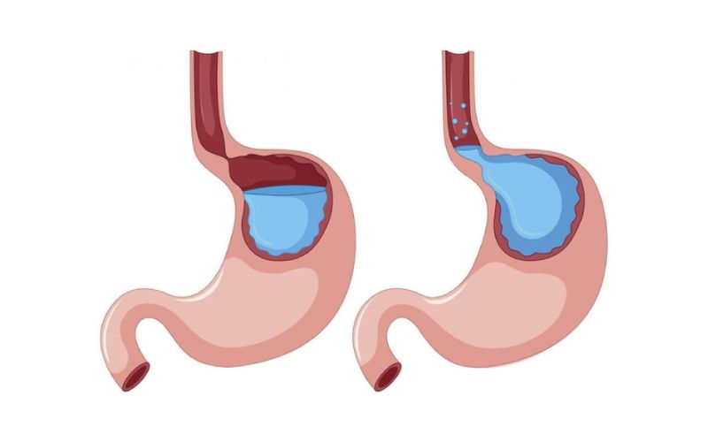 Hiện tượng đau ngực do trào ngược dạ dày xuất phát từ việc axit dạ dày trào ngược lên thực quản