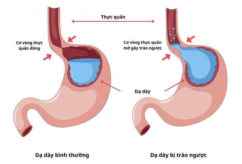 Nguyên nhân gây trào ngược và nóng rát ngực