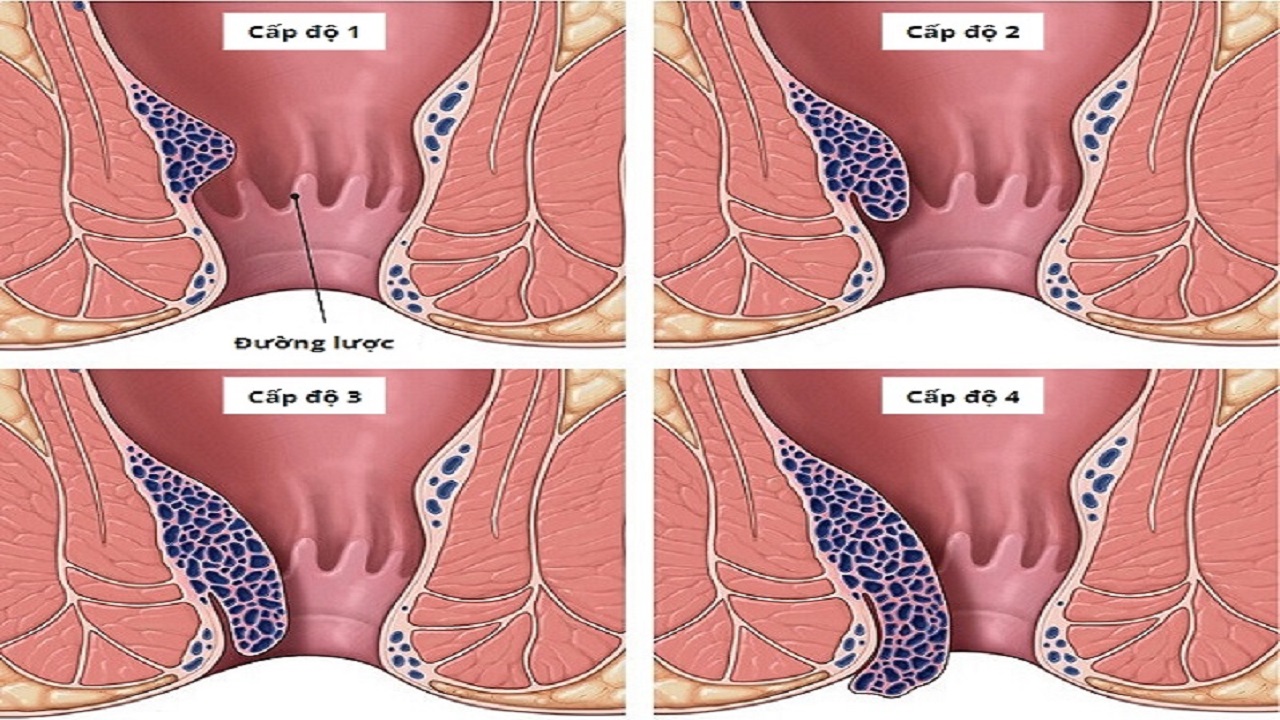 Biến chứng trĩ nội - trĩ nội được chia thành bốn cấp độ dựa trên mức độ sa búi trĩ và triệu chứng của bệnh