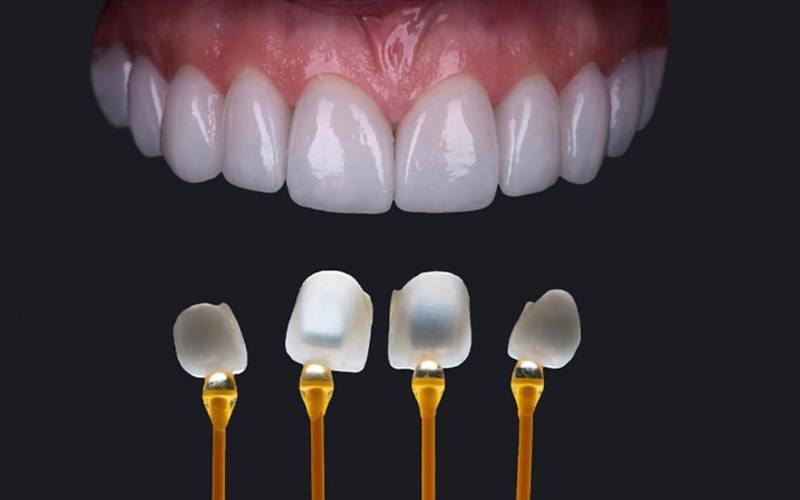 Dán sứ veneer Hà Nội nơi nào tốt