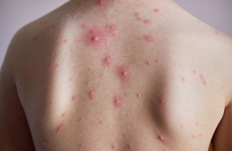 Khi nhiễm virus, cơ thể sẽ xuất hiện các nốt thủy đậu, gây ra ngứa ngáy, khó chịu và có nguy cơ để lại sẹo.