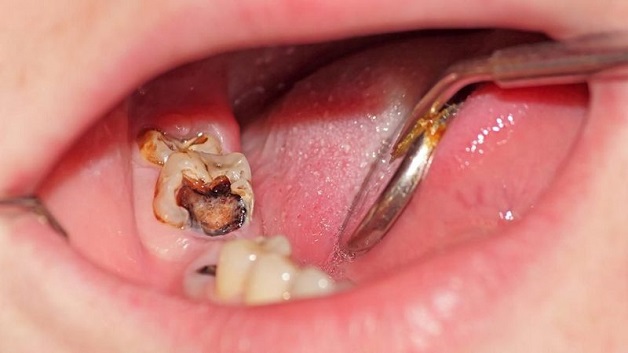Quy trình hàn răng sâu là một trong những yếu tố quan trọng khi điều trị sâu răng