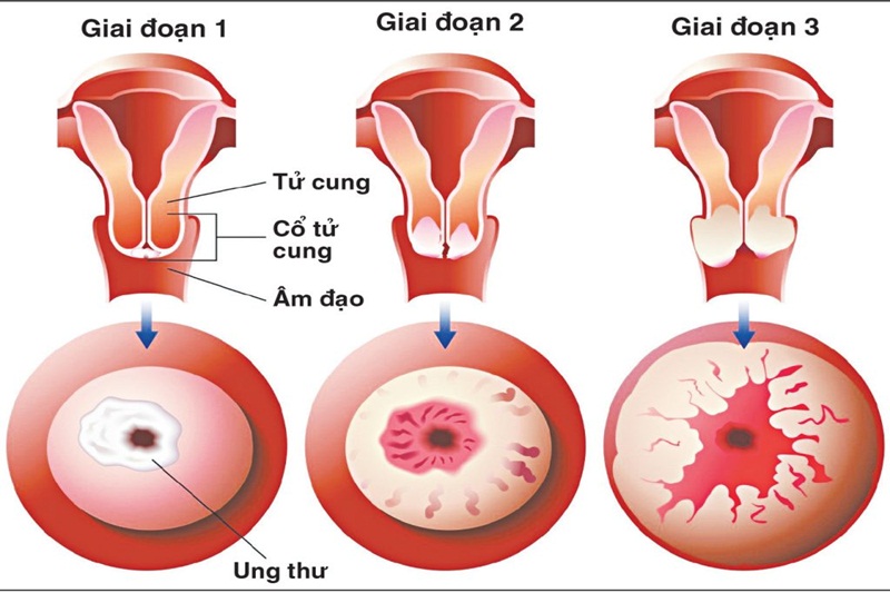 Vắc xin HPV giúp ngăn chặn sự lây lan của virus HPV.