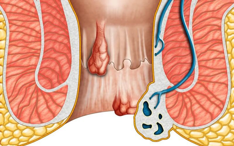 Bệnh trĩ là vấn đề nhiều mẹ bầu gặp phải trong thai kỳ