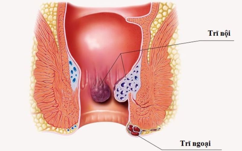 Trĩ nội và trĩ ngoại
