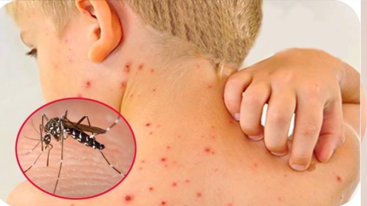 Hệ miễn dịch của trẻ chưa hoàn thiện nên phản ứng với virus Dengue mạnh và khó kiểm soát hơn