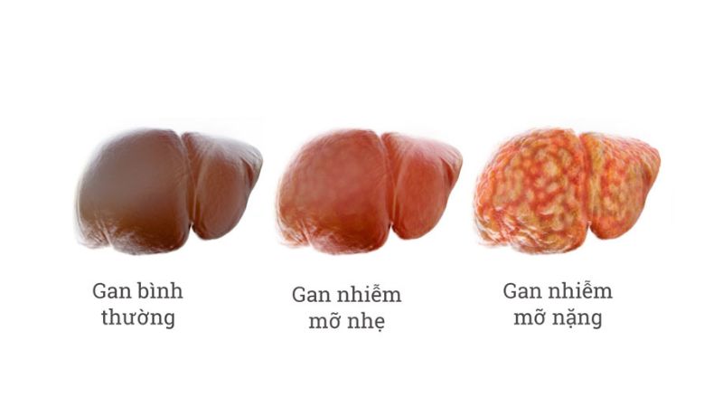 Các giai đoạn của gan nhiễm mỡ và các triệu chứng biểu hiện