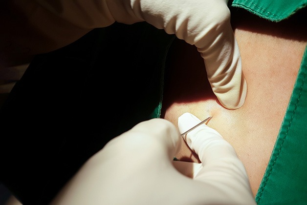 Gây tê màng cứng khi sinh thường giúp mẹ bầu có trải nghiệm đi đẻ không đau