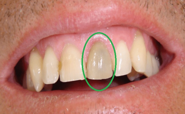 Hình ảnh răng bị hoại tử tủy đổi màu sạm