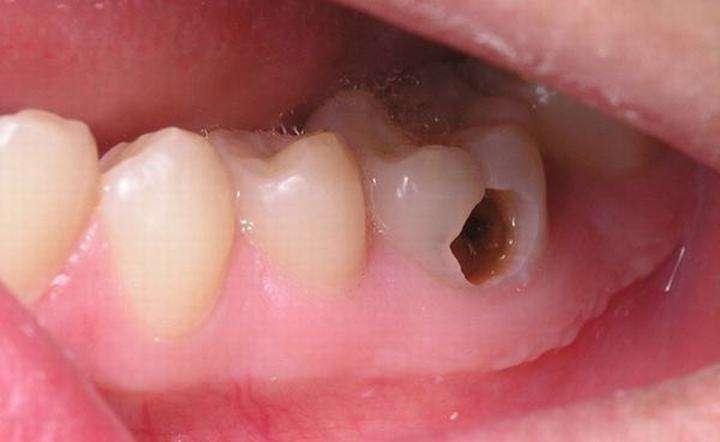 Sâu răng là nguyên nhân phổ biến dẫn đến bệnh lý về tủy răng