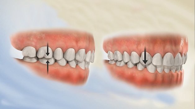 Bệnh lý về khớp cắn hay còn gọi là lệch khớp cắn, khiến sự tương quan giữa hai hàm răng trên – dưới không cân đối.