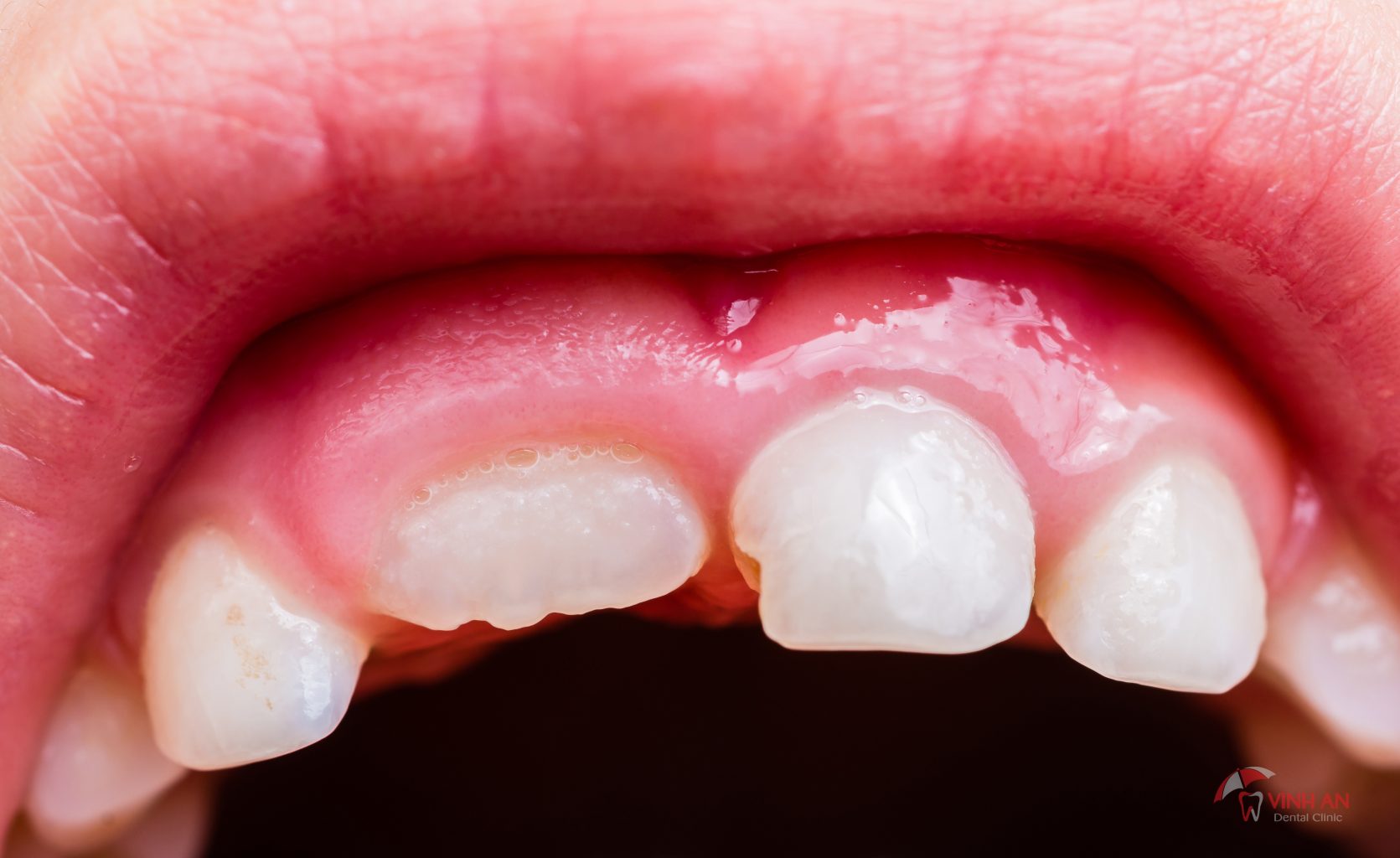 Bệnh viêm nướu ở trẻ