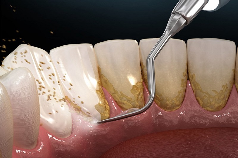 Vôi răng là lớp cặn hình thành trên bề mặt răng