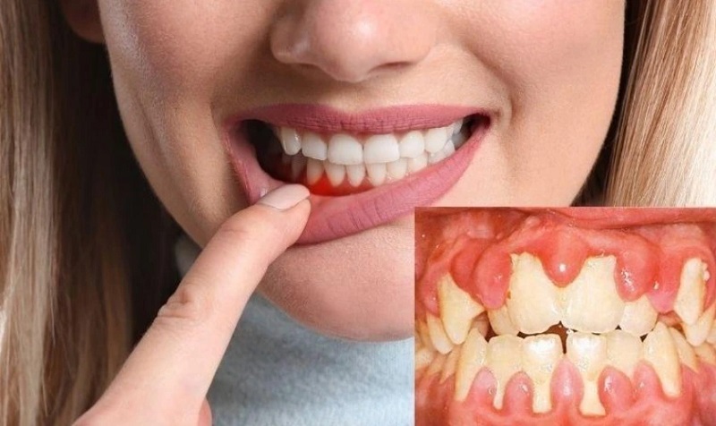 Vôi răng dẫn đến viêm nướu
