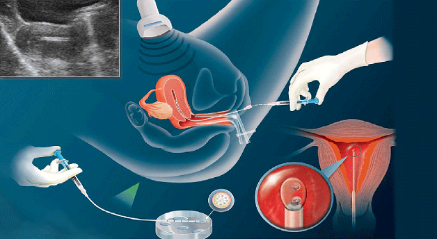 IUI là một trong những kỹ thuật hỗ trợ sinh sản phổ biến