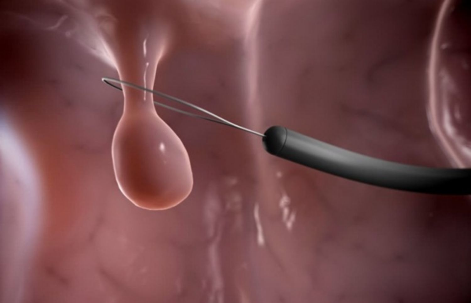 Minh họa quá trình phẫu thuật nội soi cắt polyp dây thanh