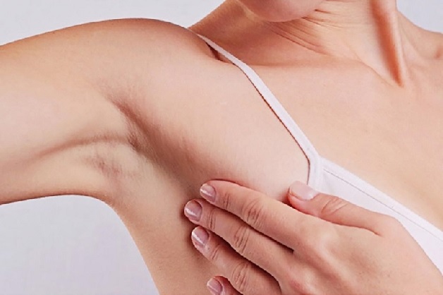 Sai khi cắt bỏ u vú, chị em có thể thấy đau âm ỉ ở vùng nách