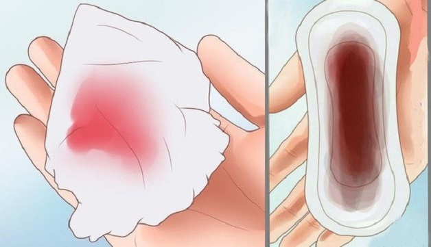 Chảy máu âm đạo là dấu hiệu của bệnh polyp âm đạo