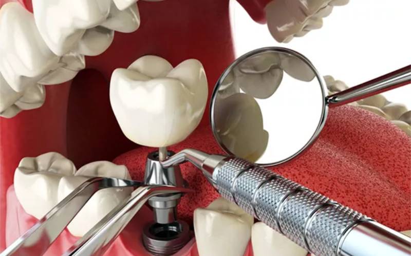 Có nên cấy ghép Implant hay là không