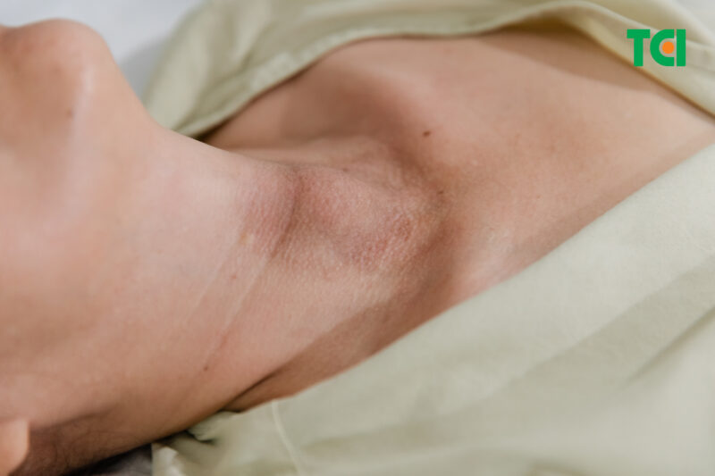 Đắp lá chữa u tuyến giáp - Hiểm họa từ phương pháp truyền miệng