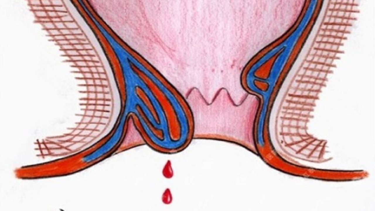 Chảy máu khi đại tiện: Người bệnh có thể thấy máu tươi trên giấy vệ sinh