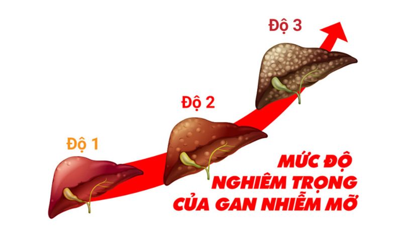 Gan nhiễm mỡ là bệnh gì và biểu hiện như thế nào?