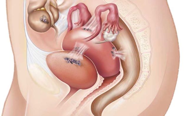 Lạc nội mạc tử cung tại tầng sinh môn là do những tế bào nội mạc tử cung dừng lại tại tầng sinh môn khi phụ nữ sinh con và có cắt tầng sinh môn