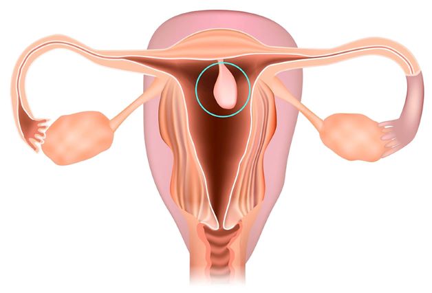 Polyp tử cung sẽ có hình dạng hình tròn hoặc bầu dục và kích thước từ vài mm đến vài cm