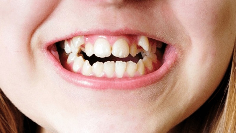 Răng cửa, răng nanh thường có chi phí thấp hơn so với răng hàm.