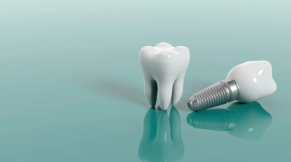 Implant nha khoa là phương pháp trồng răng giả tiên tiến, sử dụng trụ implant cấy ghép vào xương hàm.