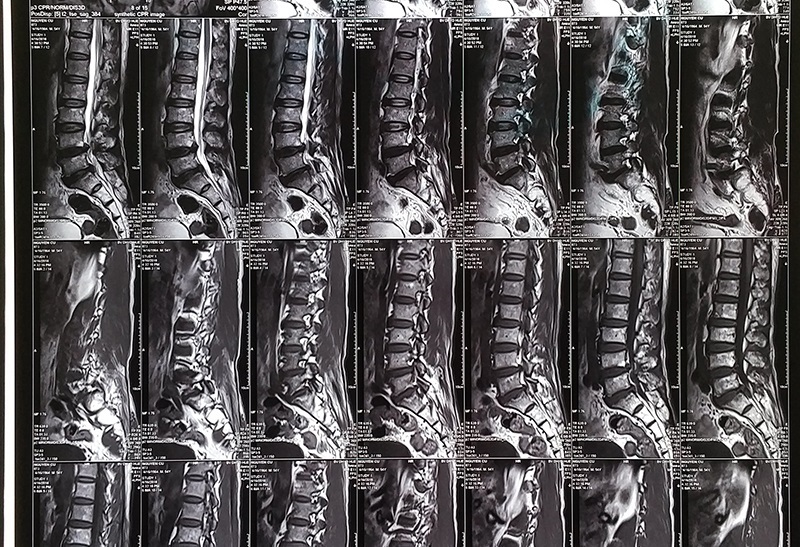 giá chụp chụp mri cột sống lưng