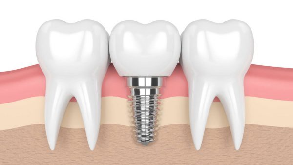 trồng răng implant