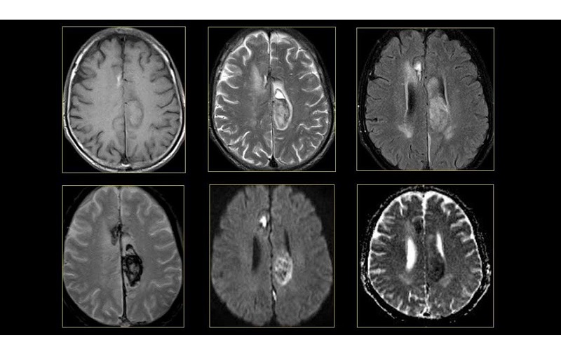 chụp MRI